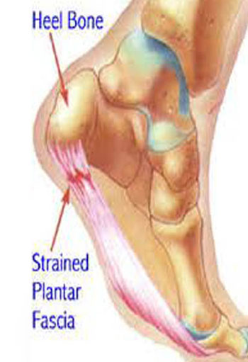Heel Pain Causes, Podiatry Delhi, Podiatric Surgeons in Delhi, Podiatry Doctors in Delhi, Foot specialist in Delhi, Causes Heel Pain solutions