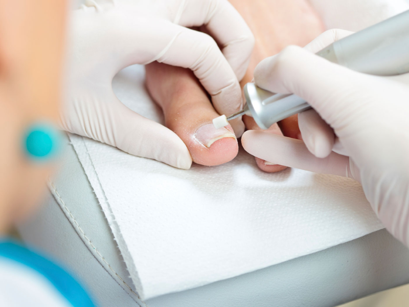 Ingrown Toenail Treatment in Delhi