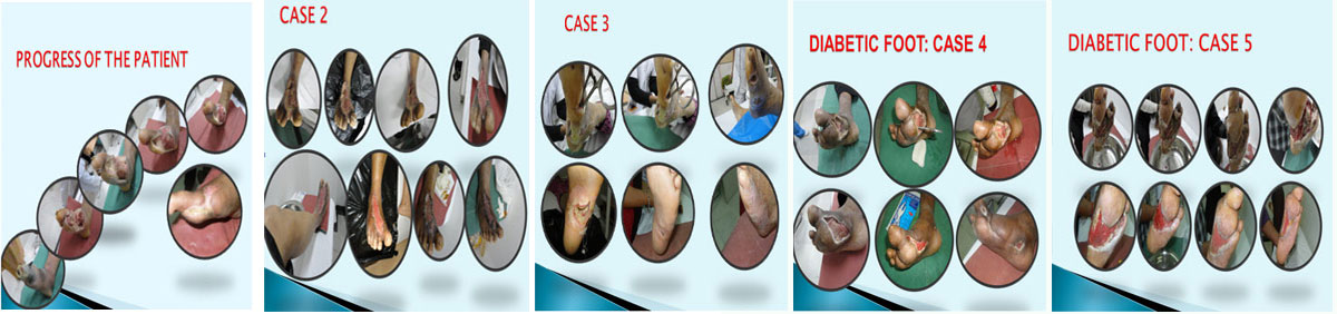 podiatry doctor delhi, foot care solutions delhi, foot care solutions in delhi